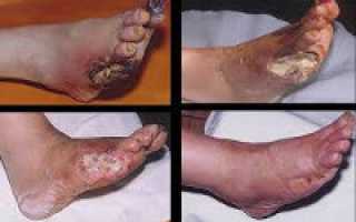 Что значит синдром диабетической стопы