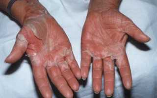 Лечение при синдроме токсического шока