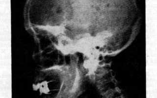 Код по мкб миелома