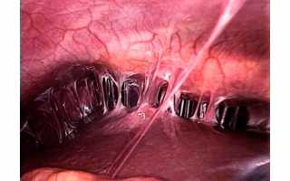 У кого был синдром ашермана