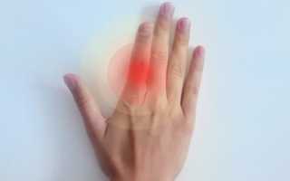 Гигрома сустава код мкб