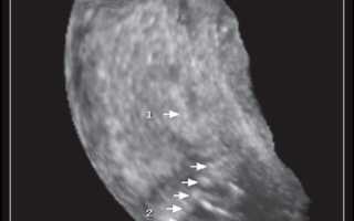 Инволютивная матка код мкб 10