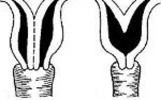 Код мкб аномалия развития матки