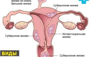 Лейомиома матки с геморрагическим синдромом