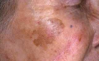 Хлоазма код по мкб 10