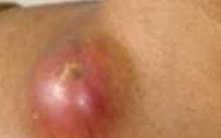 Регионарный лимфаденит код мкб