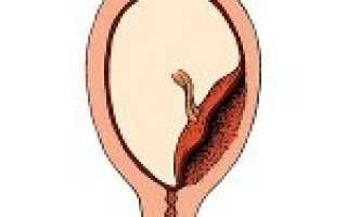 Низкая плацентация код мкб