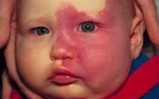 Синдром штурге вебера у ребенка