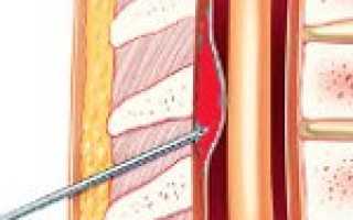 Острая субдуральная гематома код по мкб 10