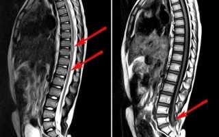 Синдром фиксированного спинного мозга у ребенка