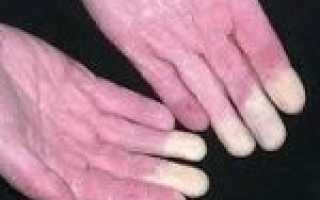 Периферический ангиодистонический синдром мкб 10