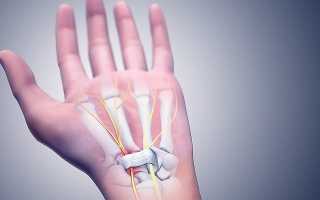 Лечение синдрома запястного канала карпальный синдром