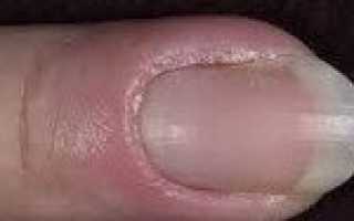 Кандидозная паронихия код по мкб 10