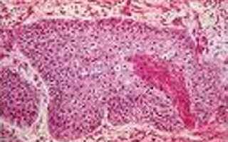 Новообразование пищевода код мкб