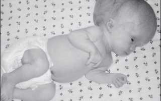 Синдром денди уокера у новорожденного