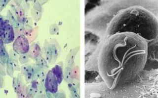 Гарднереллез код мкб 10