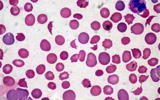 Синдром мошковица что это такое