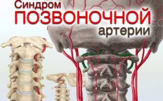 Чем лечить синдром позвоночной артерии