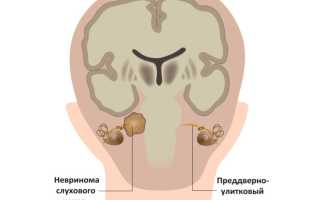 Вестибулярная шваннома код по мкб