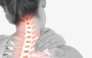 Остеохондроз шейного отдела синдром плечо кисть