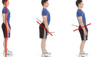 Синдром прямой спины у ребенка