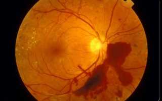 Код мкб ангиопатия обоих глаз