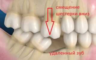 Синдром попова годона что это