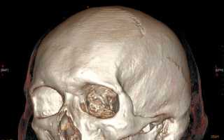 Синдром долевых и сегментарных затемнений