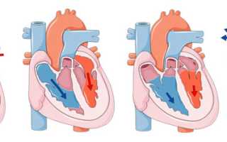 Wpw синдром и физическая нагрузка