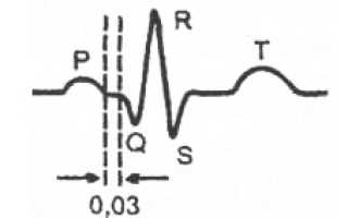 Синдром укороченного интервала q r