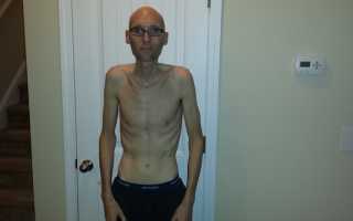 Синдром мальабсорбции у взрослых симптомы и лечение