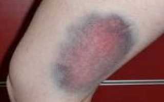 Код мкб гематома ягодичной области