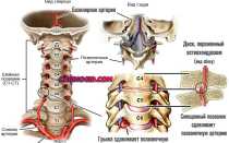 Оперативное лечение синдрома позвоночной артерии при шейном остеохондрозе