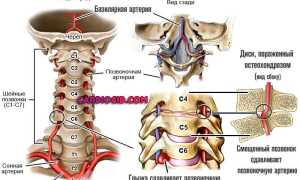Синдром позвоночник артерии что это