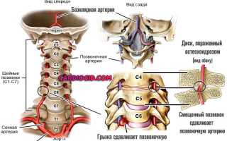 Синдром позвоночник артерии что это