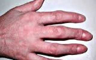 Код по мкб артрит правой кисти