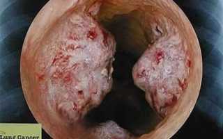 Опухоль бронха код мкб