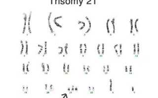 Грудные дети с синдромом дауна фото