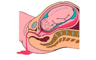 Двс синдрома преждевременная отслойка плаценты