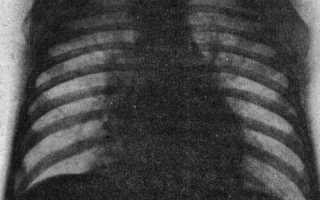 Аденовирусная код мкб 10