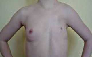 Синдром поланда код по мкб 10