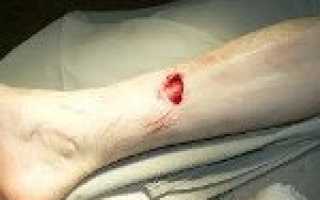 Открытый перелом большеберцовой кости код по мкб 10