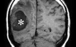 Абсцесс головного мозга код мкб