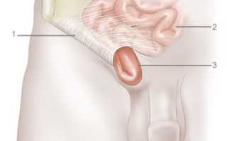 Состояние после удаления паховой грыжи код по мкб 10