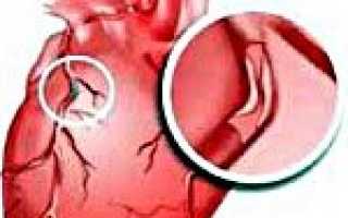 Ибс с осложнениями мкб код