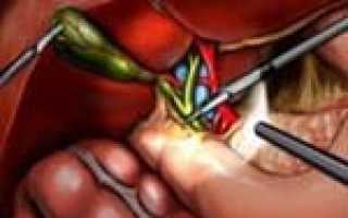 P91 код по мкб 10