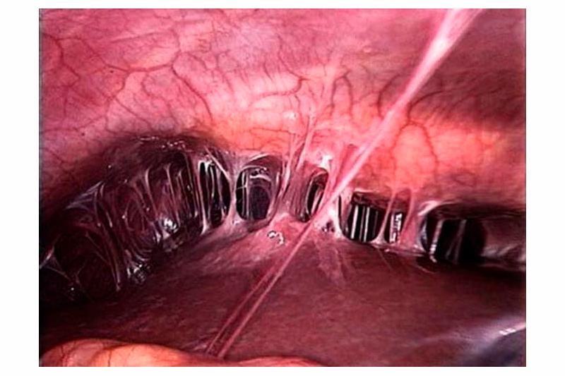 Синдром Ашермана Синдром Ашермана