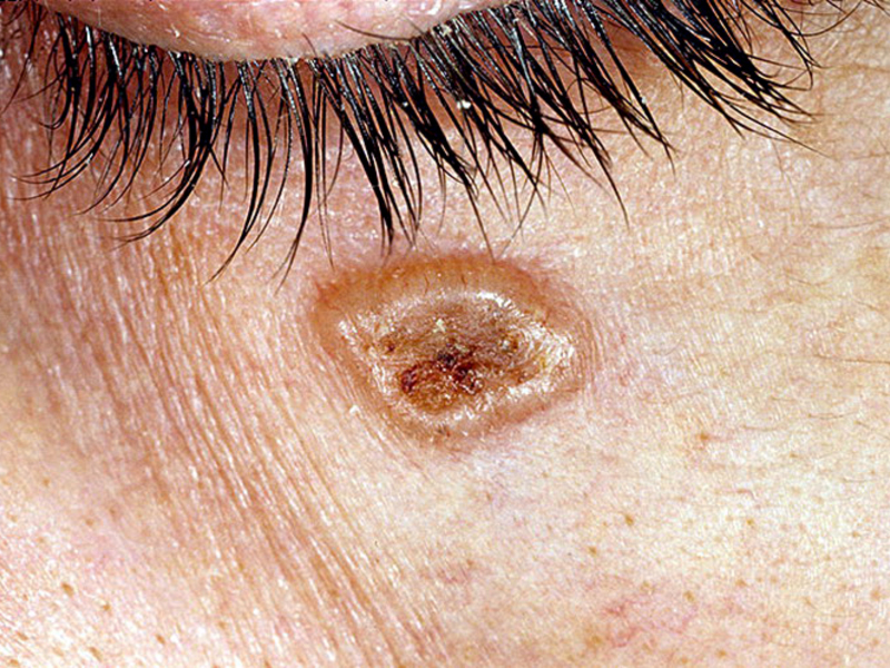 МКБ 10 – C44 – код базалиомы кожи