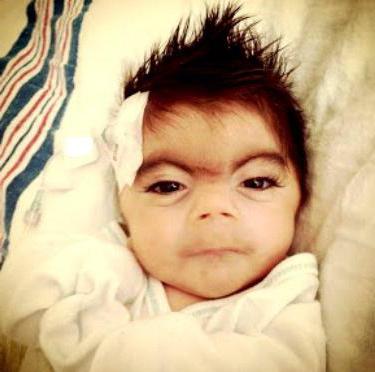 синдром Корнелии де Ланге фото