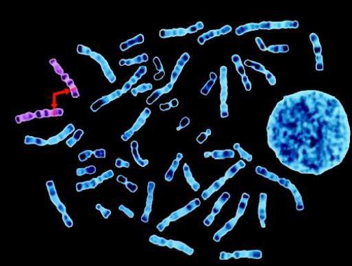 синдром Корнелии де Ланге диагностика